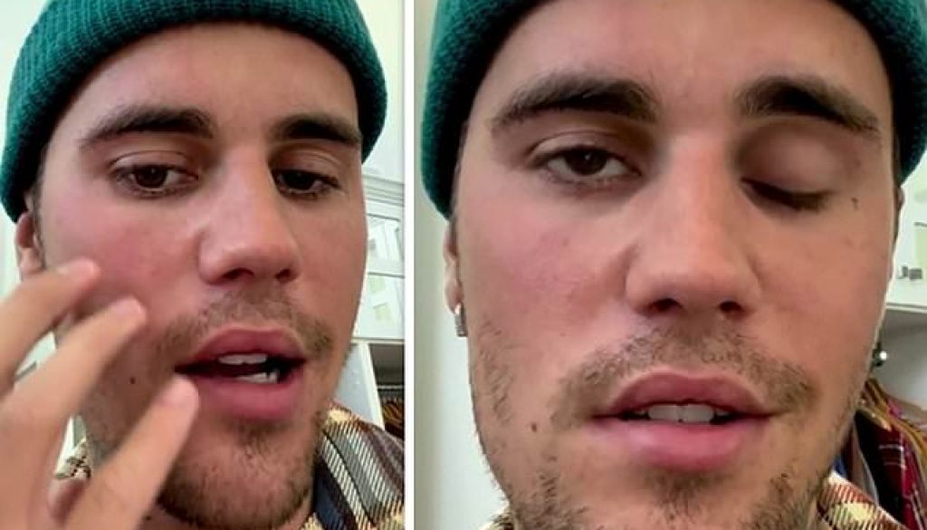 Justin Bieber Suffers Facial Paralysis Just Three Months After Wifes Scare 💉 0584